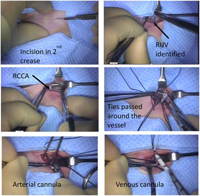 Cannulation for Neonatal and Pediatric Extracorporeal Membrane Oxygenation for Cardiac Support